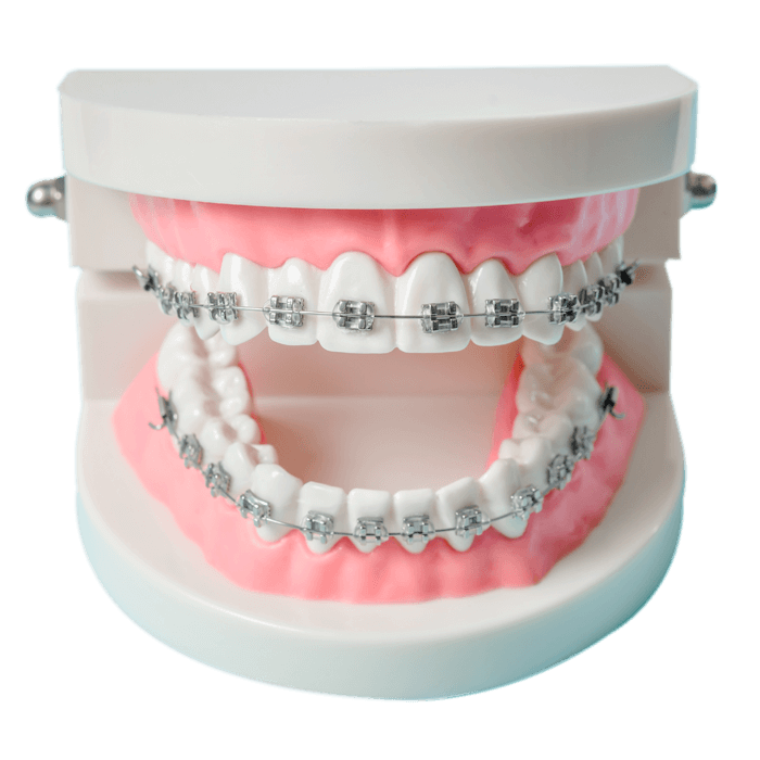 Model de dantura ce arata aparatul dentar